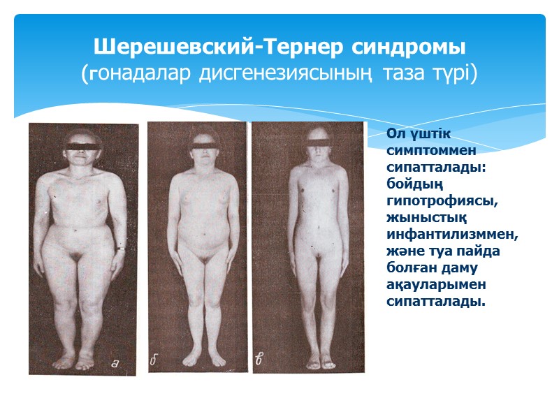 Шерешевский-Тернер синдромы  (гонадалар дисгенезиясының таза түрі) Ол үштік симптоммен сипатталады: бойдың гипотрофиясы, жыныстық